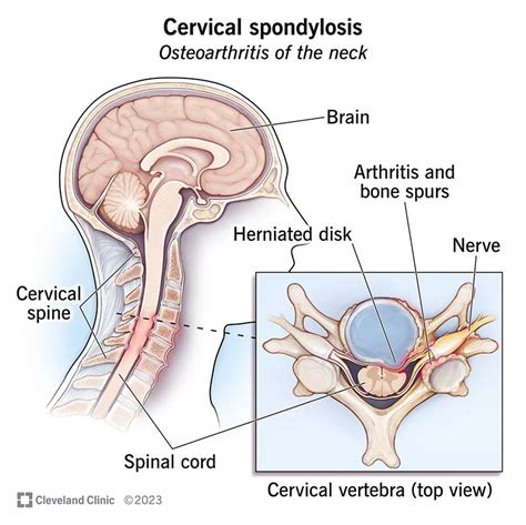 Cervical Spondylosis Causes