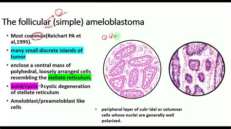 Ameloblastoma HISTOPATHOLOGY,types,Radiographic features,clinical ...