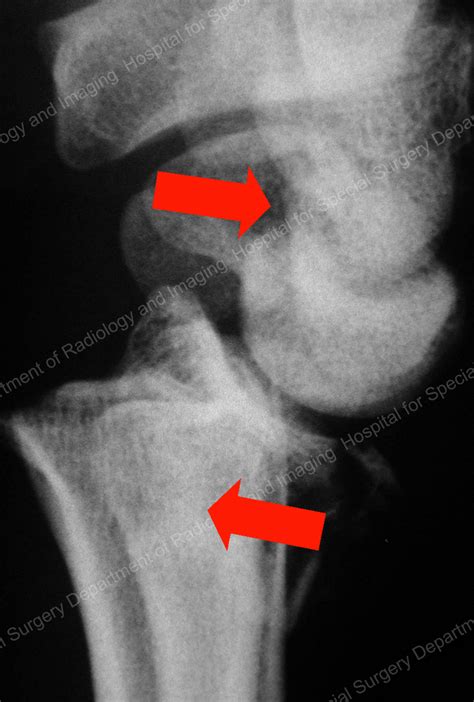 Avoiding Distal Radius Fracture Complications Broken - vrogue.co