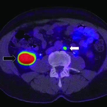 Image from urethroscopy depicting bladder neck stenosis in a patient ...