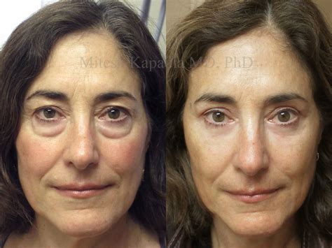 Kétértelműség tanácsadás Vidám laser blepharoplasty before and after udvar valószerű eredményesen