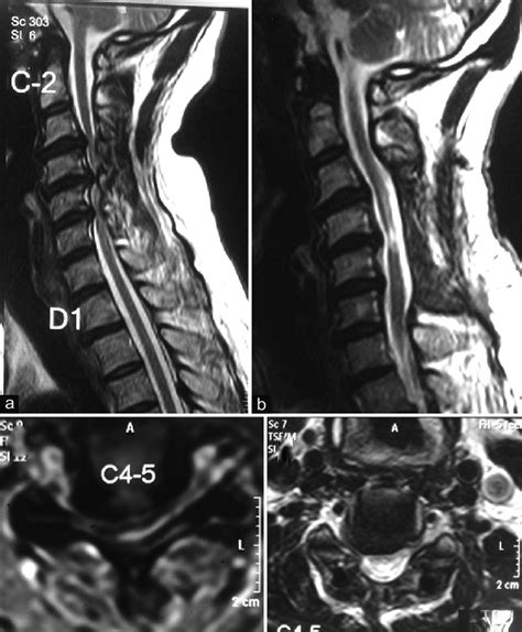 Cervical Spondylosis Mri