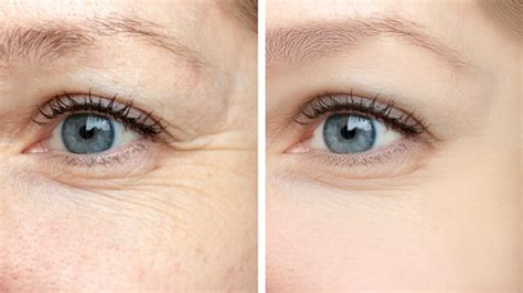 Wrinkles and Fine Lines: Causes, Prevention, And Treatments