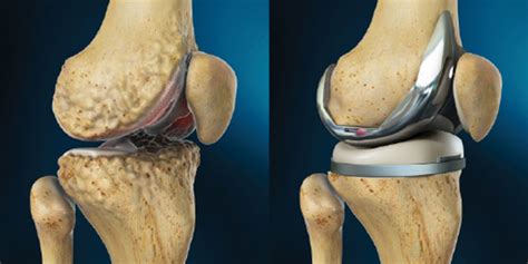 #Total Knee Replacement Treatment in Thane | Dr Kuldeep Gadkari