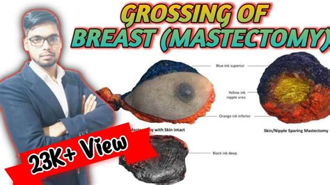 Lecture -1||Grossing of Breast (Mastectomy) By SWAG Channel in Hindi ...