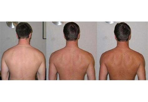 Before and after Melanotan tanning therapy, sunless tanning results | Best self tanner, Best ...