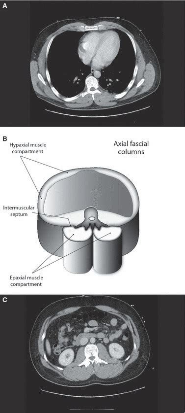 The thoracolumbar fascia: anatomy, function and clinical considerations. - PubMed - NCBI ...