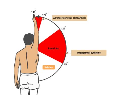 Shoulder Pain Subacromial Impingement Syndrome