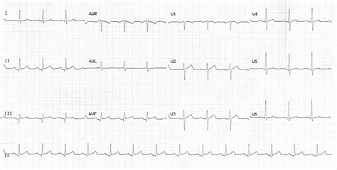 Myocardial Ischaemia • LITFL • ECG Library Diagnosis