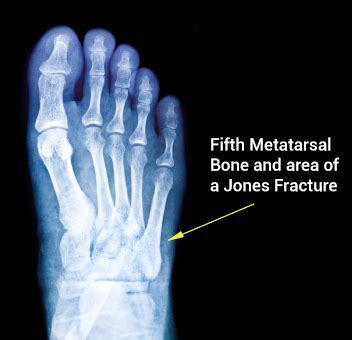 Jones Fracture: Symptoms, Causes, Treatments Surgery and Recovery