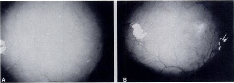 (a) Photographs of the bulbar conjunctiva shows blanching and isolated... | Download Scientific ...