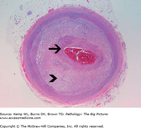 Vascular Pathology | Basicmedical Key