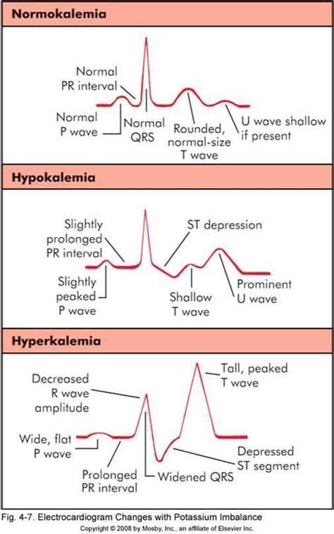 ECG/EKG and the importance of Potassium (K+). In short, very important ...