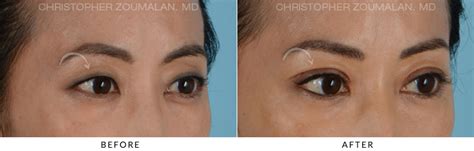 Asian Eyelid (Double Eyelid) Surgery Before and After Photo Gallery