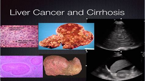 Liver Cirrhosis And Cancer