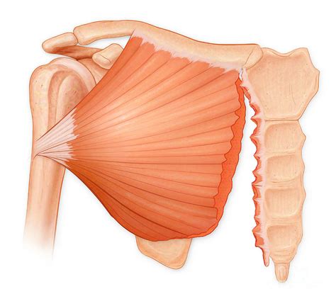 Pectoralis Major Tendon Tear