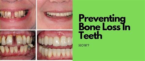 How To Prevent Further Bone Loss In Teeth - Follow These Tips Now! | Mouth Ninja