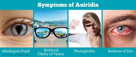 Aniridia - Causes, Symptoms, Diagnosis & Treatment