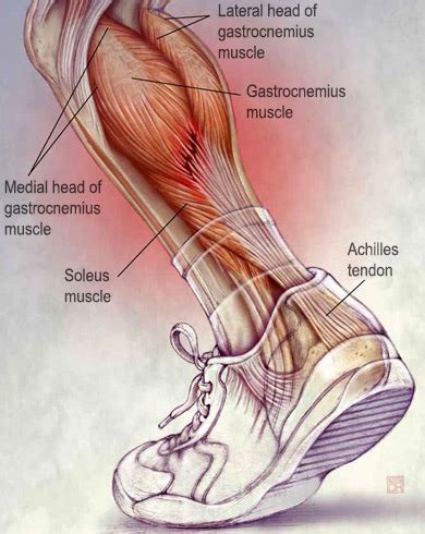 Chronic Achilles Tendon Pain: Diagnosis & Treatment | HSS