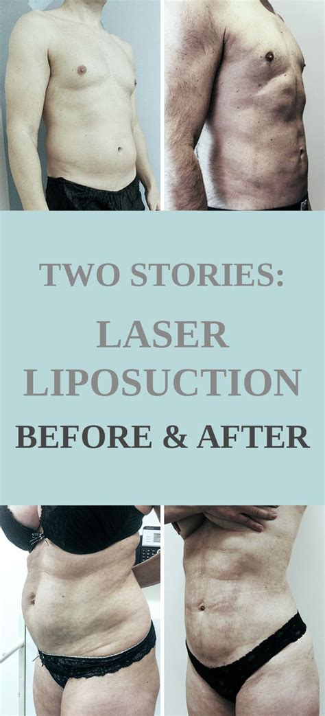 Two Stories: Laser Liposuction Before and After | The Sculpture Clinic ...