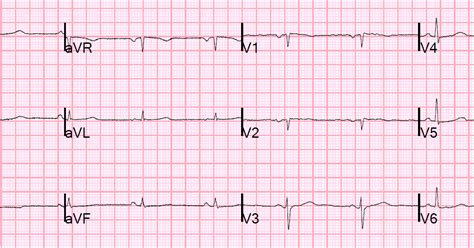 Dr. Smith's ECG Blog: Chest Pain and Q-waves in V1 and V2. Is there ...