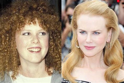 Nicole Kidman before and after plastic surgery – Celebrity plastic ...