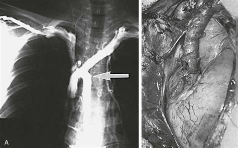 Superior Vena Cava Obstruction | Thoracic Key