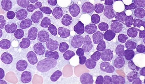 Chronic Lymphocytic Leukemia - 2.