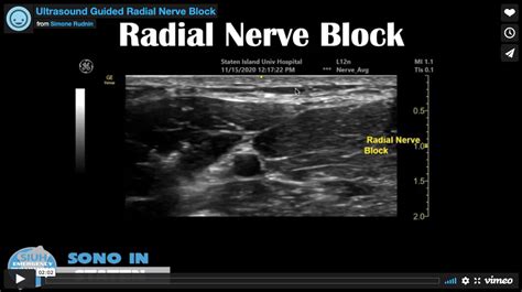 Ultrasound Guided Radial Nerve Block — SIUH Emergency Residency Program