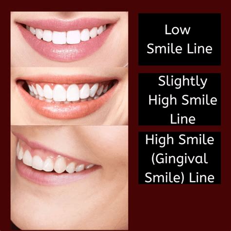 What is the Gingival Smile Line? - West Palm Beach Dentist