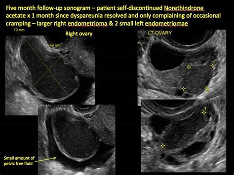 Imaging the endometrioma and mature cystic teratoma | MDedge ObGyn