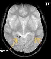 Chronic Trauma with Diffuse Axonal Injury-MRI - Sumer's Radiology Blog