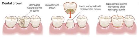 Crown and Bridge: Dental Crowns and Bridges