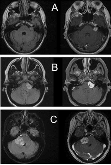 Examples of radiographic appearance of vestibular schwannoma with ...