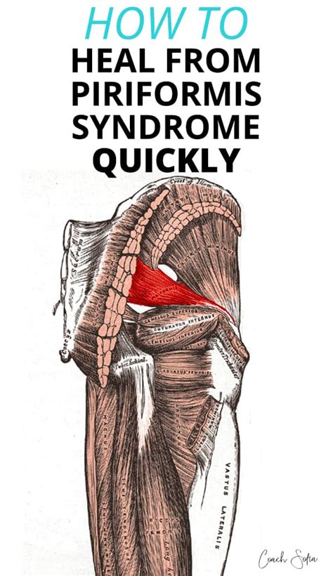 How To Relieve Piriformis Syndrome - Aimsnow7