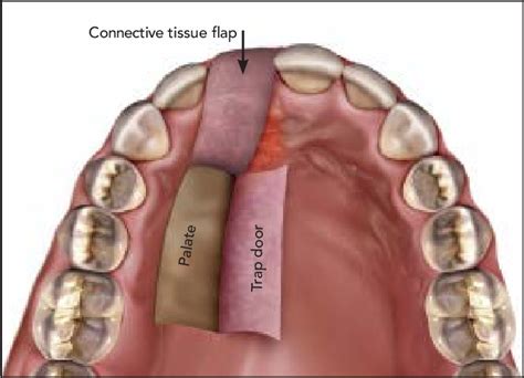 The donor site for the pedicle graft began approximately at the distal... | Download Scientific ...