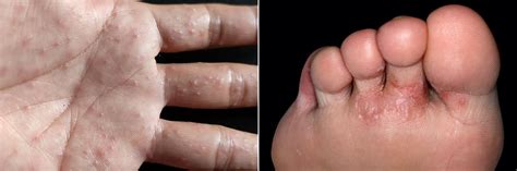 The Many Types and Causes of Foot Blisters - Blister Prevention