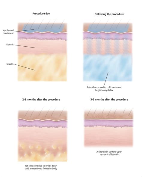 20 Maximizing Safety with Cryolipolysis | Plastic Surgery Key