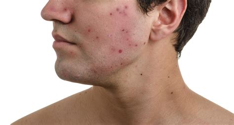 Can Low Testosterone Cause Acne