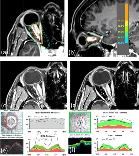 Long-term treatment outcomes of patients with primary optic nerve sheath meningioma treated with ...