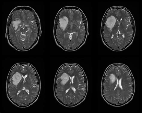 Dr Balaji Anvekar FRCR: Anaplastic Astrocytoma MRI