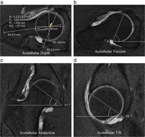 Acetabular labral tear description and measures of pincer and cam-type femoroacetabular ...