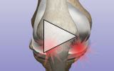 Revision Total Knee Replacement: Frequently Asked Questions (FAQs ...