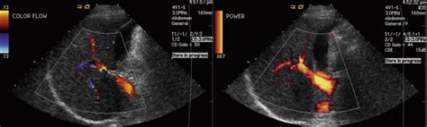 Ultrasound Artifacts | Radiology Key