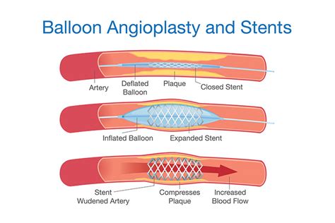 New York Balloon Angioplasty | NYC