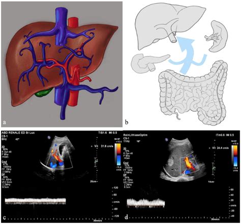 Hepatofugal Portal Venous Flow: From Normal to Pathological | Radiology ...