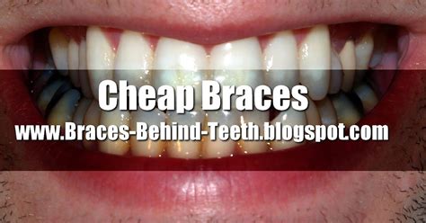 How to Save Big Money on Cheap Braces!