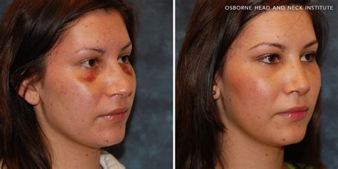 Broken Nose Treatment Los Angeles, CA