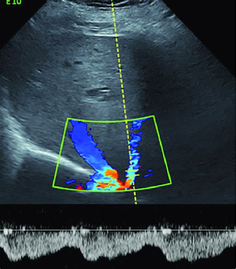 Color Doppler ultrasonogram of the liver showing patency of the hepatic... | Download Scientific ...