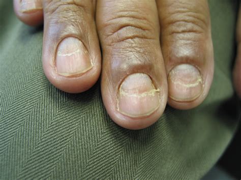 An Atlas of Nail Disorders, Part 4 | Consultant360